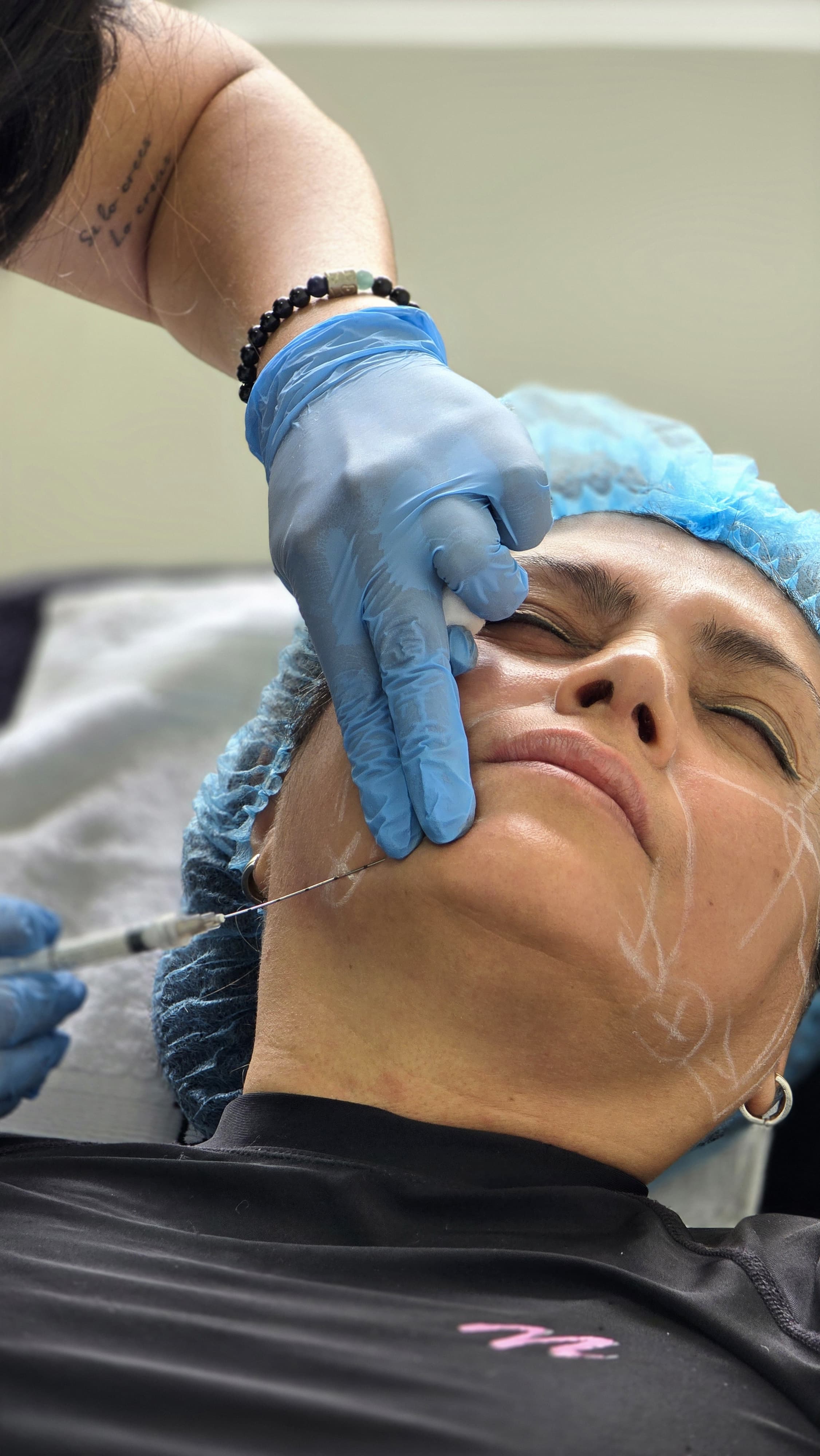 Bioestimuladores y bioregeneradores de colágeno